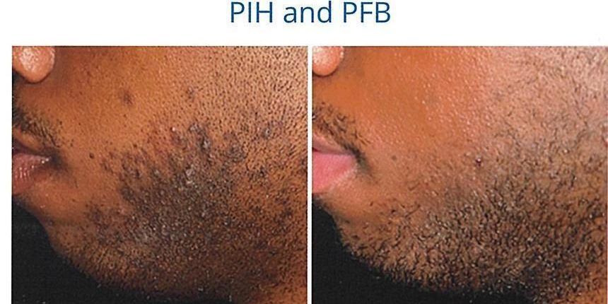 aerolase pih and pfb before and after