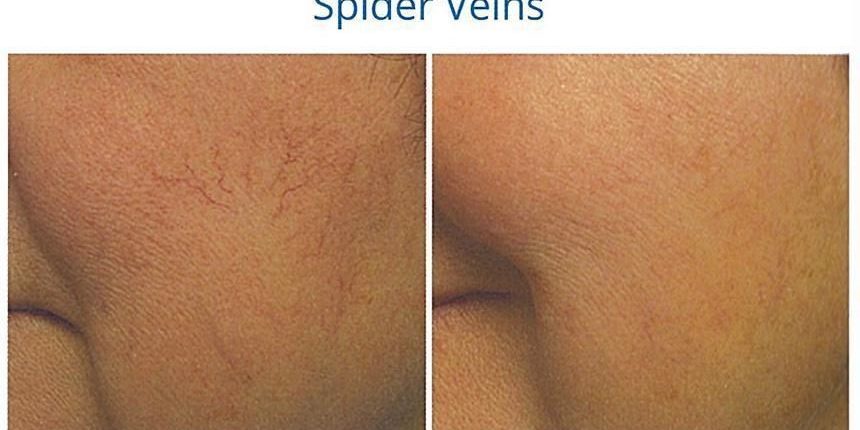 aerolase spider veins before and after