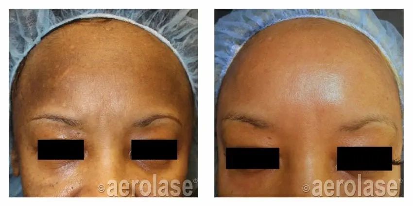 aerolase forehead before and after