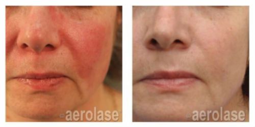 aerolase before and after