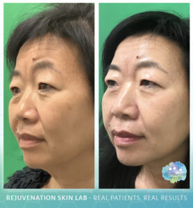 Rejuvenation Skin Lab - Morpheus8 Before & After
