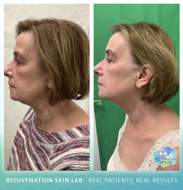 Rejuvenation Skin Lab - Morpheus8 Before & After