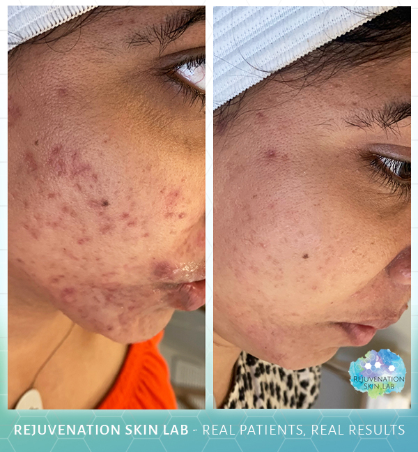Rejuvenation Skin Lab - Before & After