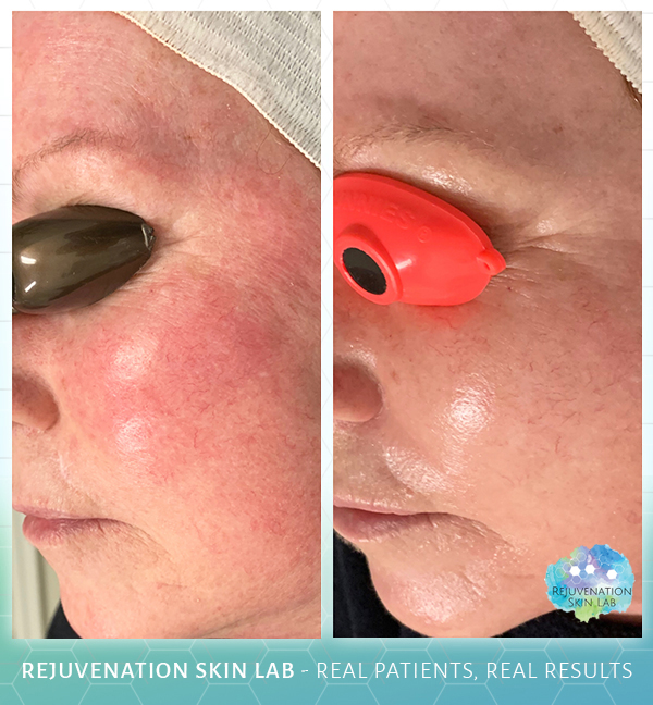 Rejuvenation Skin Lab - Before & After