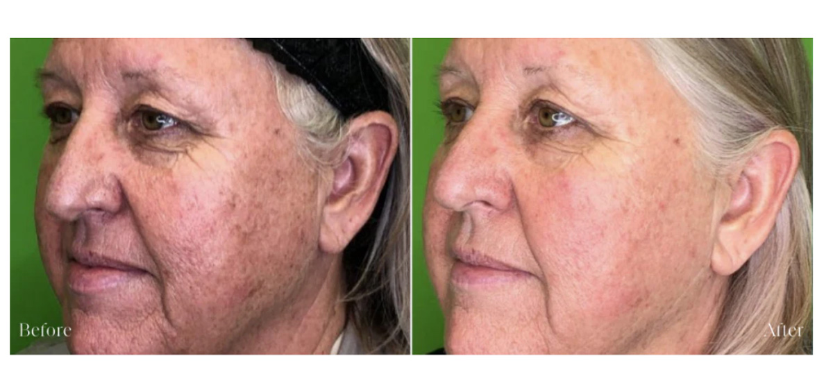 Side-by-side images of before and after exosome treatment on a patient’s face.