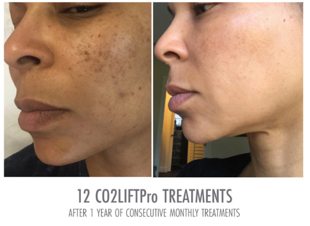 Side-by-side images of before and after C02 lift pro treatment on a patient’s face.
